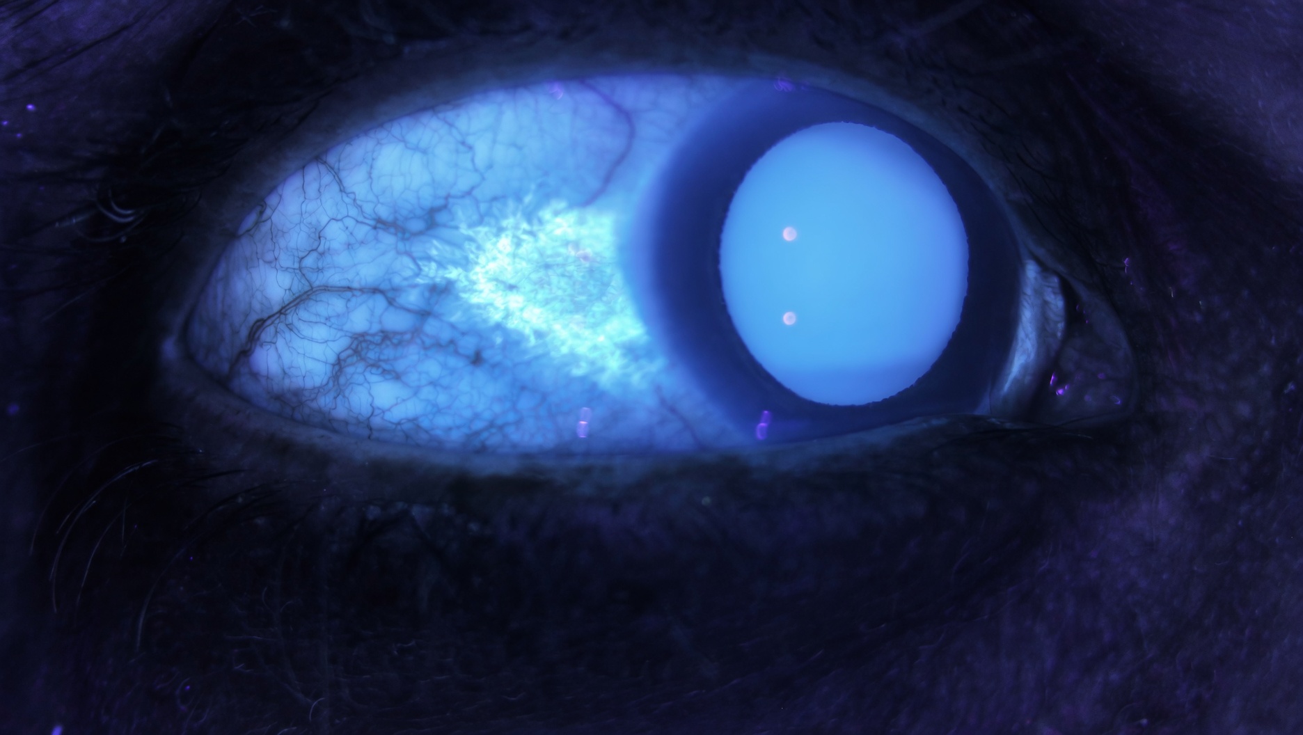 El mismo ojo bajo UV-A: amplia área de fluorescencia conjuntival